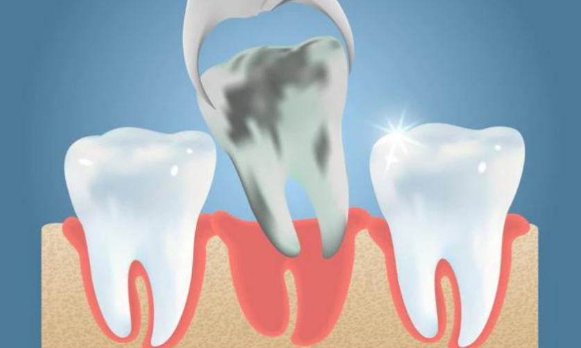 Wisdom Tooth Surgery