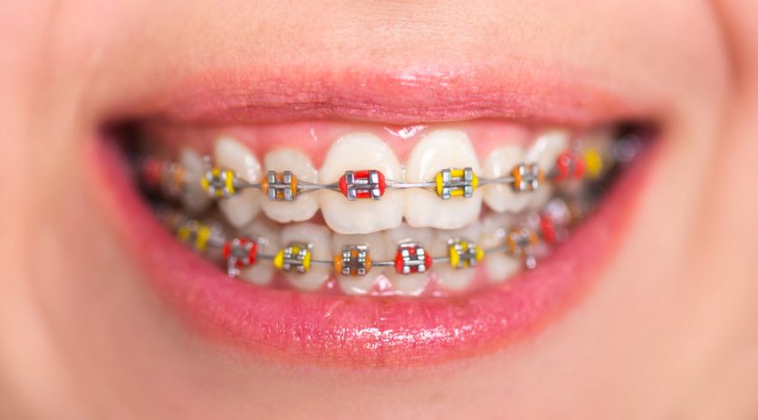 Colorful Braces