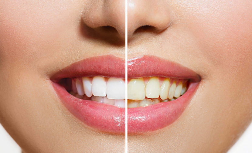 braces before and after Overbite