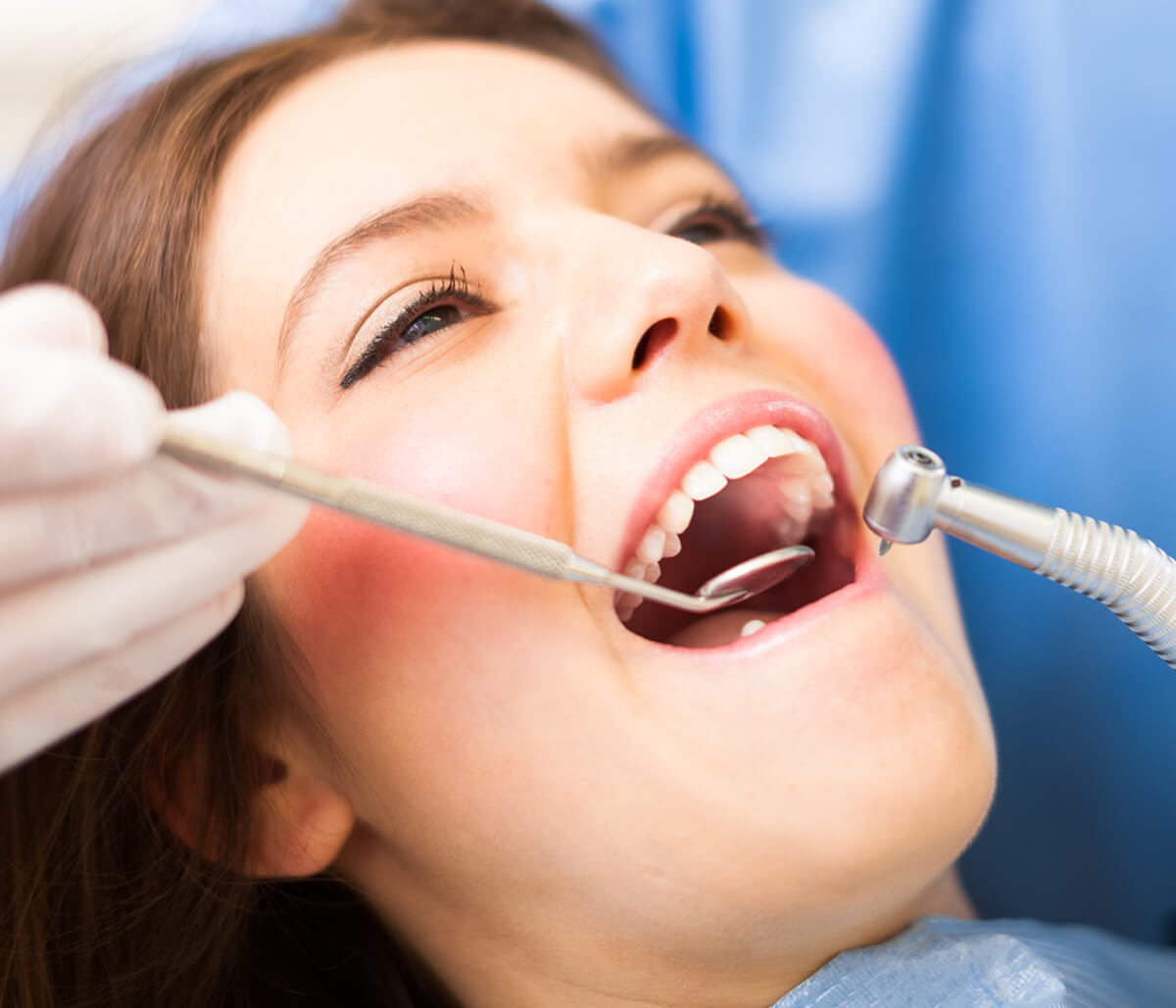 Dental Fillings Houston