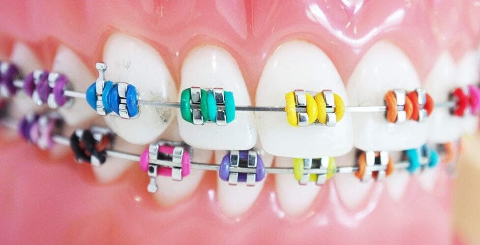 Braces Color