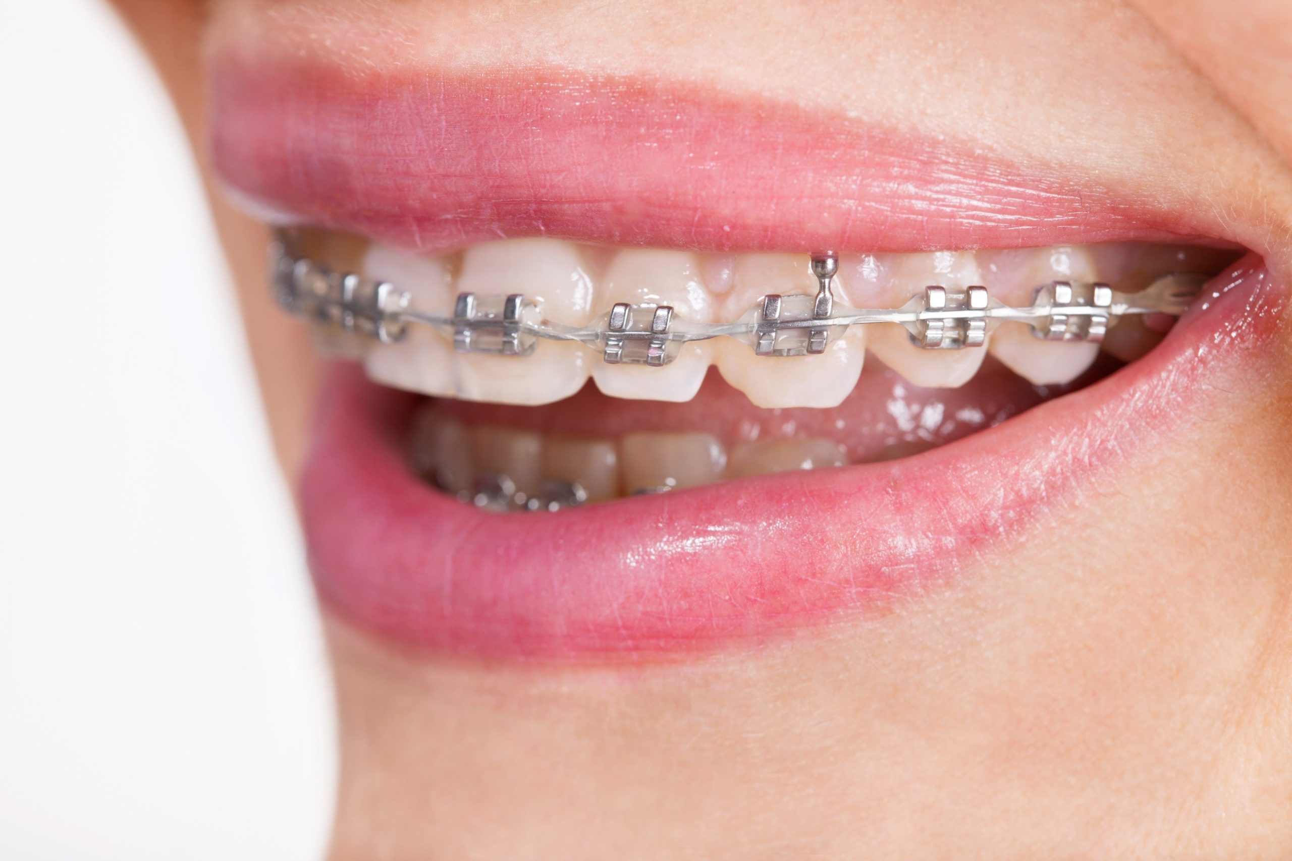 Invisalign miami beach