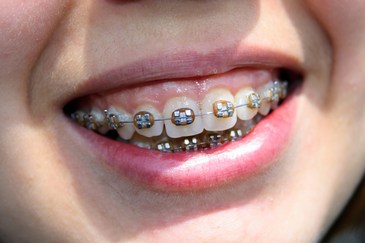 affordable braces near me