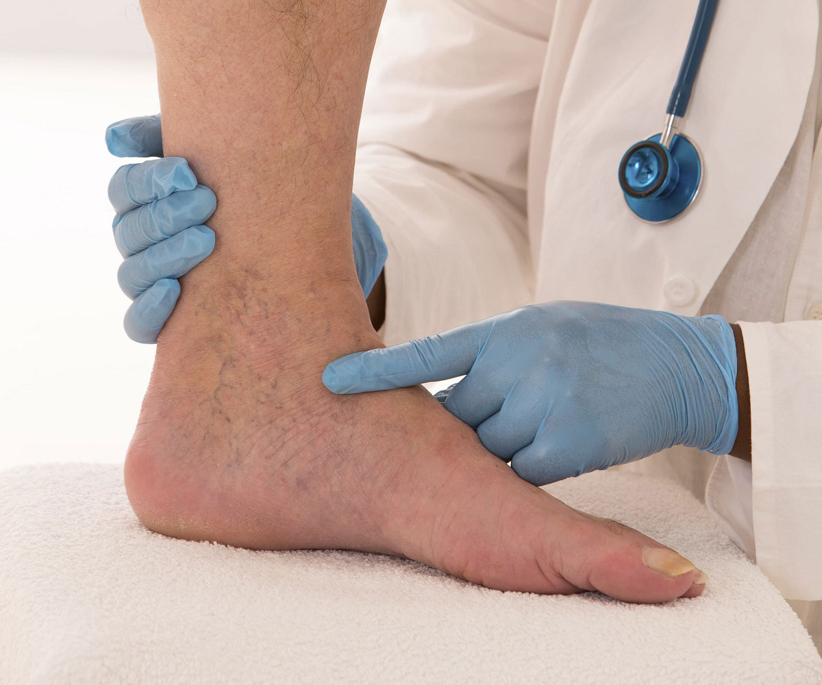 How Much Does Varicose Vein Treatment Cost