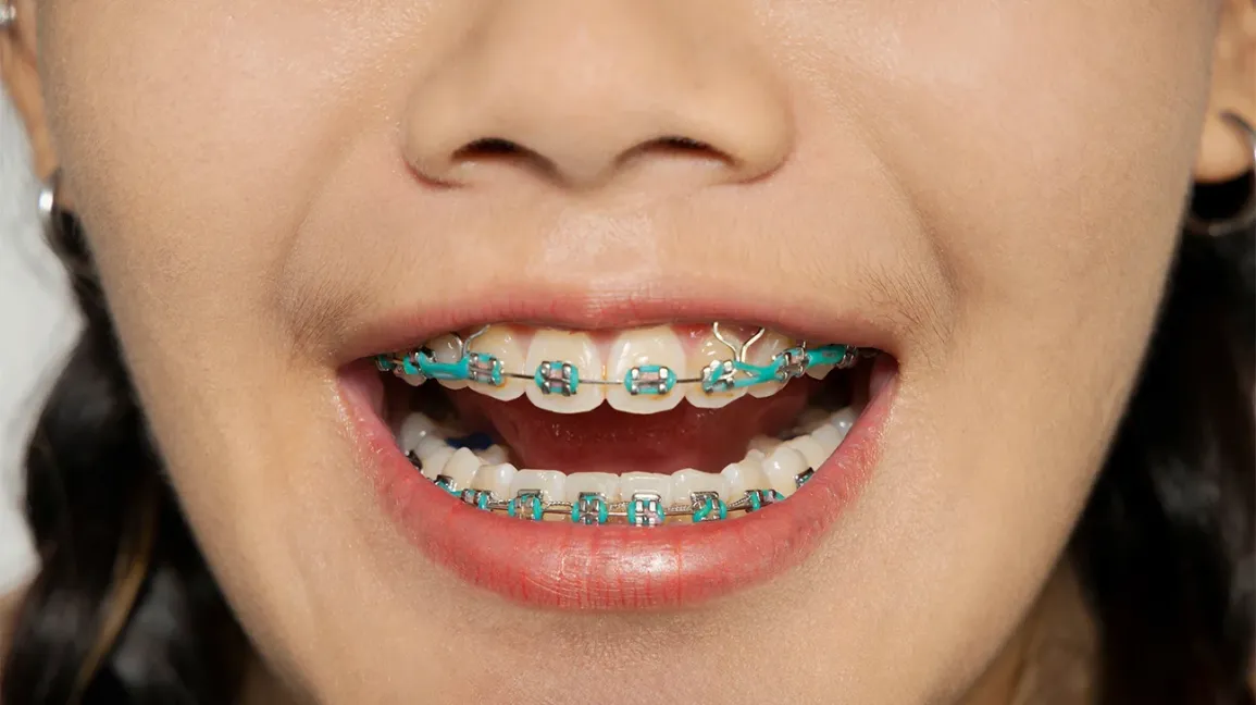 braces band colors