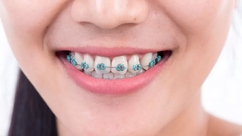 Braces
