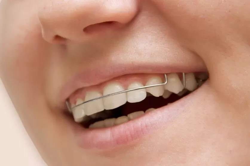 Retainers
