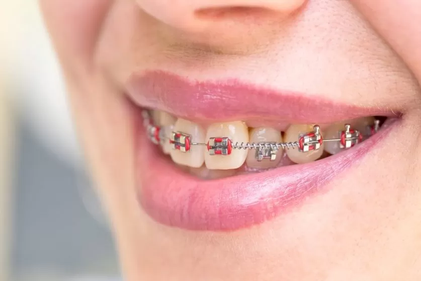 braces color