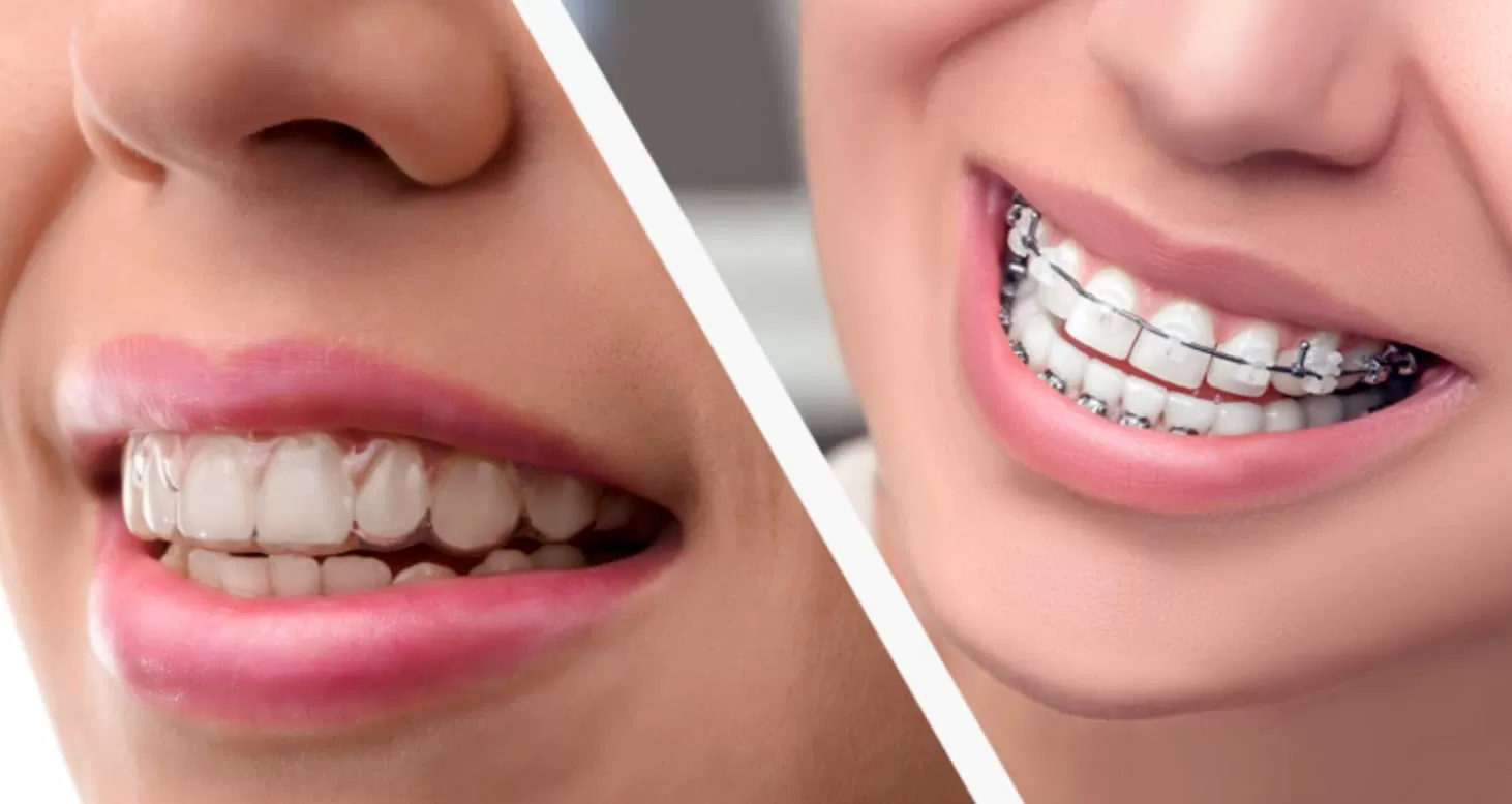 braces before and after Overbite